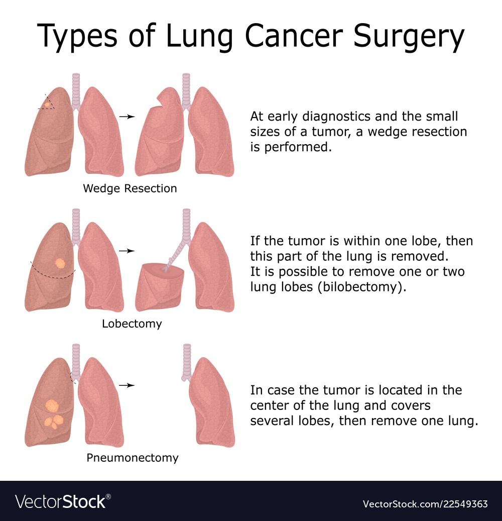 Lung Cancer Surgery MEDICINE FOR WORLD